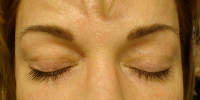 11-17-10_Brows_After_Healed.JPG
