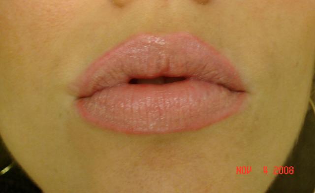 11-4-08_After_healed_from_white_pigment_treatment_copy.jpg