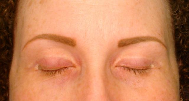 2-13-15_Brows_after_Healed.JPG