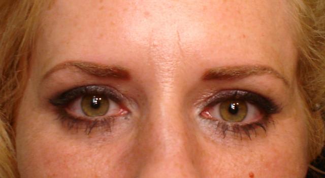 2-24-16_Brows_after_healed.JPG
