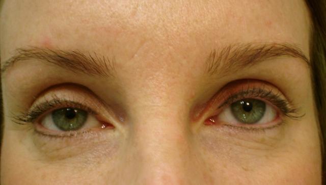 3-9-07_eyes_after_healed_-_Copy.jpg