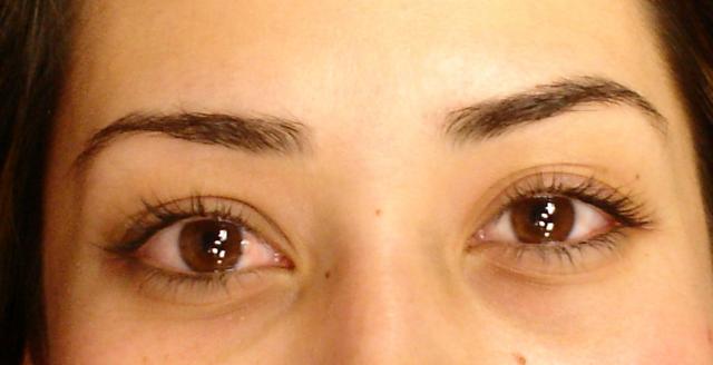 4-12-11_Eye_Before.JPG