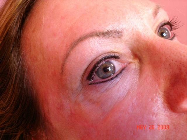 5-28-09_Eyes_After_side_view.jpg
