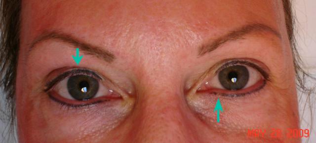 5-28-09_Eyes_Before.jpg
