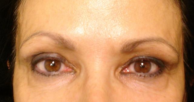 6-25-12_Brows_Before.JPG