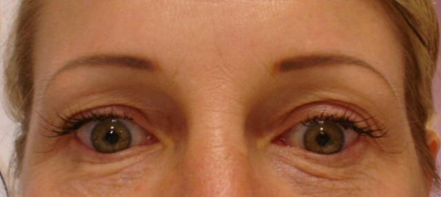 7-19-11_Brows_After_healed.JPG