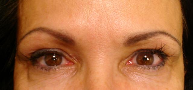 7-30-12_Brows_After_Healed.JPG